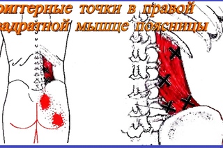 Боль в спине. Квадратная мышца поясницы. Миофасциальный синдром (триггерная точка).