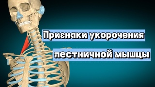 Признаки укорочения лестничной мышцы