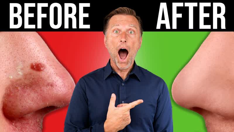 The BEST BLACKHEAD Acne Remedy in the World ( One Time