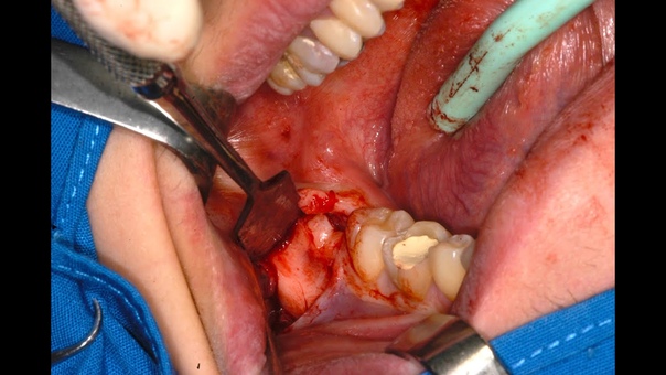 Horizontally impacted wisdom tooth