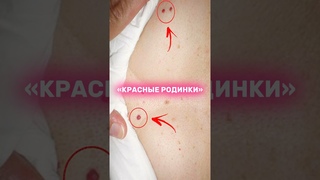Красные точки на теле. Чем опасны гемангиомы? Как избавиться?