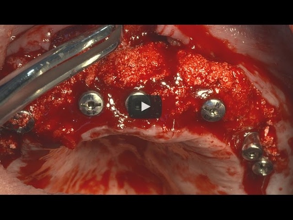 Implant supported fixed prosthesis for full mouth